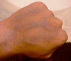Bruise